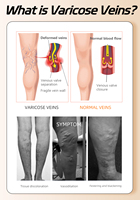 Collants de compression respirants sans pieds 15-20 mmHg |   Soulagement de la douleur et de l'enflure des jambes