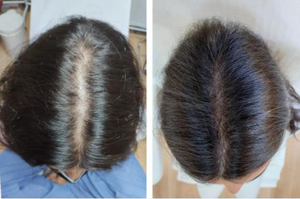 Hạt nhân KN-8000C Laser cap lllt liệu pháp ánh sáng đỏ tăng trưởng tóc Mũ bảo hiểm cho điều trị rụng tóc hói đầu giải pháp - Product Image 6