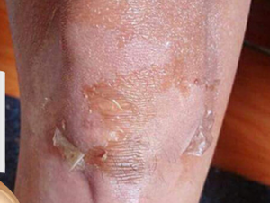 Crema Exfoliante para Eliminar <span class=keywords><strong>Cicatrices</strong></span> Antiguas en las Piernas, <span class=keywords><strong>Aceite</strong></span> Blanqueador para la Piel - Product Image 5