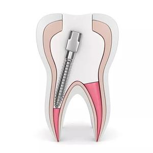 Vis dentaire manuelle en titane/plaqué or/acier inoxydable, broches coniques pour canal radiculaire, classe II - Product Image 5