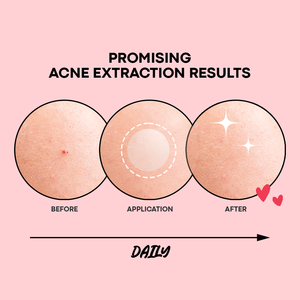 Patch de tache claire Patch d'acné Invisible hydrocolloïde guérison rapide étanche pour les peaux sensibles végétalien maquillage coréen amical - Product Image 6