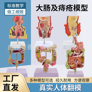 Modelo patológico de intestino grueso, modelo de intestino grueso, modelo gastrointestinal, modelo de enfermedades del colon humano, anatomía de lesiones - Product Image 5
