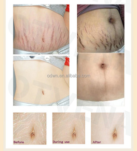 OTVENA Crème Raffermissante Haute Qualité pour le Corps, Élimine les Cicatrices de Grossesse, Traitement de l'Acné, Vergetures, Réparation et Brûle-Graisse - Product Image 4