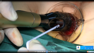 Tek kullanımlık hemoroid zımba üç büyük pencereler <span class=keywords><strong>pph</strong></span> dairesel zımba 34mm - Product Image 4