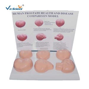 Ciencia Médica lesión de próstata humana modelo anatómico el modelo de educación enferma de próstata - Product Image 1