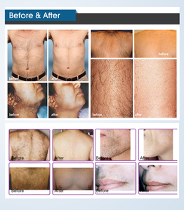 <span class=keywords><strong>Ce</strong></span> được phê duyệt xách tay 808 Diode Máy tẩy lông bằng <span class=keywords><strong>laser</strong></span> giá 755 808 1064nm Diode Máy tẩy lông bằng <span class=keywords><strong>laser</strong></span> - Product Image 5