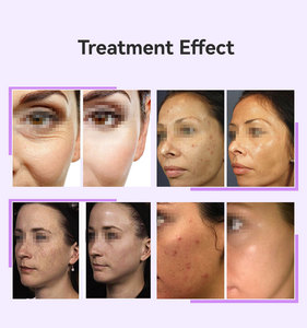 Baguette de thérapie de la peau portable 5 en 1 baguette d'électrode au néon niveaux de puissance réglables pour les soins des rides et de l'acné - Product Image 2