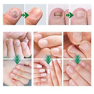 Gel Reparador de <span class=keywords><strong>Uñas</strong></span> con Hidratación y Reducción de Decoloración para <span class=keywords><strong>Uñas</strong></span> Dañadas - Tratamiento para <span class=keywords><strong>Hongos</strong></span>, Envase Individual - Product Image 4