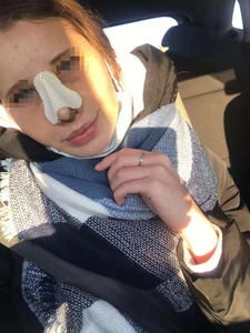 Attelle nasale thermoplastique <span class=keywords><strong>Aquaplast</strong></span> pour rhinoplastie chirurgie du nez fixation rééducation des fractures en taille 225*500/450*600mm - Product Image 3