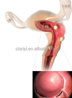 Gynécologie 980 1470nm Laser Atrophie Vaginale Fibromes utérins Fibromes ovariens Traitement Chirurgie Clinique Hémorroïdes EVLT PLDD
