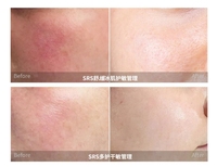 Kit d'ampoules régénérantes pour la peau coréenne, soin professionnel du visage, ensemble de solutions Matrigen SRS, sérum apaisant régénérant