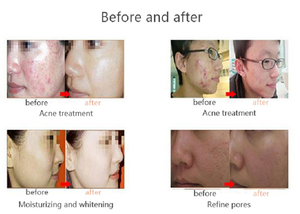 Máquina de Rejuvenecimiento Facial de Última Generación para Uso Doméstico, para Reparar la Piel Envejecida, Piel Propensa al Acné, Aclarar Manchas y Aliviar Quemaduras Solares - Product Image 4