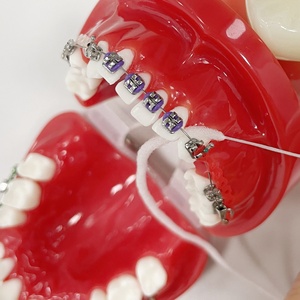 <span class=keywords><strong>Implant</strong></span> prédécoupé en nylon super orthodontique ciré pour l'expansion du pont Utilisation à la menthe pour le nettoyage - Product Image 6