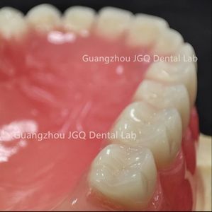 ฟันปลอมอะคริลิกคุณภาพสูงแบบสั่งทำพิเศษ ช่วยฟื้นฟูการทำงานและรูปลักษณ์ของฟันให้กลับมาเป็นธรรมชาติ - Product Image 3