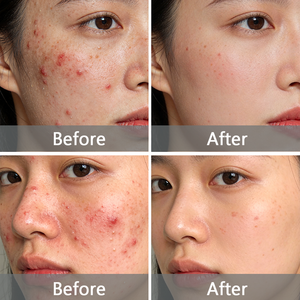 Crème anti-acné à <span class=keywords><strong>l</strong></span>'<span class=keywords><strong>acide</strong></span> <span class=keywords><strong>salicylique</strong></span>, réduit les boutons et les points noirs, anti-rougeurs, gel éliminateur <span class=keywords><strong>de</strong></span> cicatrices et <span class=keywords><strong>de</strong></span> taches, resserre les pores pour une peau lisse - Product Image 4