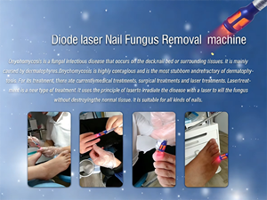Système de diodes professionnel 980 nm pour le traitement des mycoses des ongles des pieds et des mains - Product Image 3