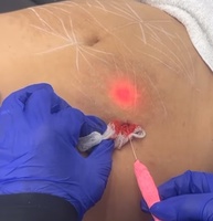 Machine de liposuccion laser à diode 980nm1470nm façonnant le lifting facial Endolaser à lipolyse amincissante