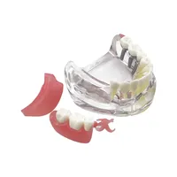 Modelo de Dientes de Mandíbula Inferior Removible con Implante, Restauración de Puente, Modelo de Implante Dental para Educación, Enseñanza, Estudio y Práctica