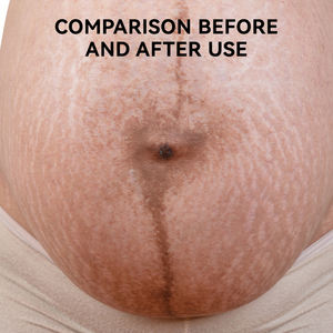 Minyak <span class=keywords><strong>Bio</strong></span> MULAN untuk Stretch Mark, Losion Penghilang Stretch Mark, Melembapkan, Menutrisi, Memperbaiki, Minyak Stretch Mark - Product Image 4