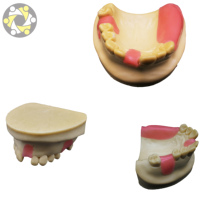 Modèle d'implant dentaire personnalisable pour la science médicale, avec dent manquante en résine, 11x10x6 cm, pour l'enseignement et la pratique