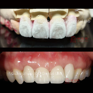 Couronne et ponts personnalisables en céramique de porcelaine à haute résistance de zircone pour les <span class=keywords><strong>dents</strong></span> antérieures et postérieures - Product Image 2