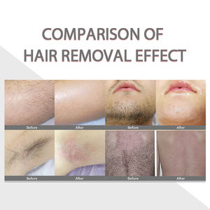 Diode laser 808 nm de dernière technologie 2026 pour l'épilation - Product Image 5