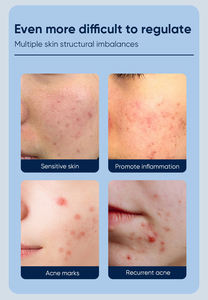 MOIKA 개인 라벨 퀵 안티 여드름 살리실산 얼굴 젤 여드름 흉터 치료 허브 여드름 제거 젤 - Product Image 2