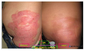 Lámpara de Terapia de Luz UV Portátil Mini KN-4006BL de 311nm para Psoriasis y Vitíligo |   Cuidado de <span class=keywords><strong>la</strong></span> <span class=keywords><strong>Piel</strong></span> para Uso Doméstico - Product Image 6