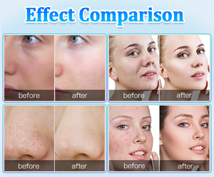 Máquina Facial 4 en 1 con Pulverizador Hydra, Exfoliante Facial, Reafirmante y Tensor de Piel, Terapia de Oxígeno con Burbujas de CO2 para el Hogar y Salón - Product Image 5