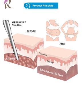 معدات شفط الدهون بالموجات فوق الصوتية مع ضمان خدمة لمدة 5 سنوات، أدوات شفط الدهون لتشكيل الجسم - Product Image 5
