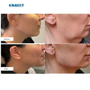 GOMECY 60W 980nm Medische Lasertherapie Endo <span class=keywords><strong>Laser</strong></span> Lift 1470nm Lipolyse Vetverwijdering Minimaal Invasieve Esthetische Chirurgie - Product Image 6