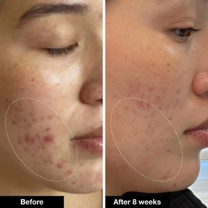 Sérum <span class=keywords><strong>d</strong></span>'huile <span class=keywords><strong>d</strong></span>'arbre à thé <span class=keywords><strong>de</strong></span> marque privée OEM ODM traitement <span class=keywords><strong>de</strong></span> l'acné dissolvant <span class=keywords><strong>de</strong></span> boutons raffinage des pores sérum facial anti-acné blanchissant - Product Image 4