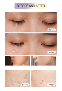 Láser fraccional de CO2 todo en uno de 60w para eliminación de pigmentos, lifting facial, máquina láser de CO2 con pantalla grande para uso en salones de belleza - Product Image 3
