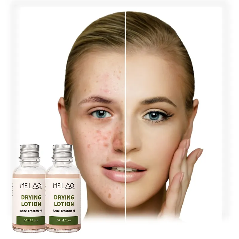 MELAO Natural Acne Acne Spot brufolo trattamento e sbiancamento Ance cicatrice crema siero lozione essiccante