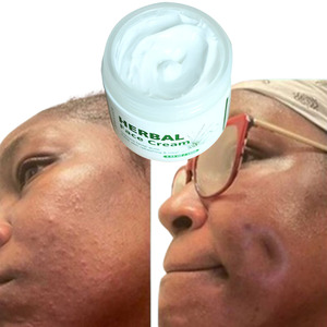 Private Label Herbal Rosto Creme Melhorar Rosto Acne Clareamento Branco Creme Poro Minimizando <span class=keywords><strong>Skincare</strong></span> Produtos De Beleza Agentes - Product Image 3