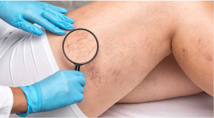 Laser dioda 1470nm, perangkat perawatan bedah varicoevlt/mesin penghilang vaskuler pembuluh darah Spider - Product Image 5