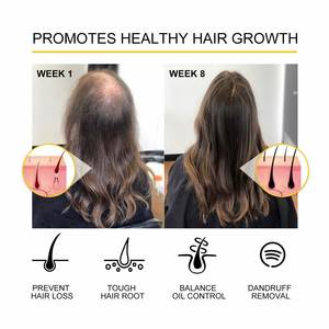 OUHOE Grosir Label Pribadi Menutrisi Kulit Kepala Merangsang Pertumbuhan Rambut Meningkatkan Kepadatan Rambut Minyak Esensial Pertumbuhan Rambut 30Ml - Product Image 6