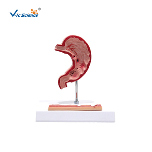 Modèle d'ulcère gastrique et de perforation : Montre l'évolution de la gastrite à l'ulcère perforant pour l'enseignement médical et la formation en pathologie - Product Image 3