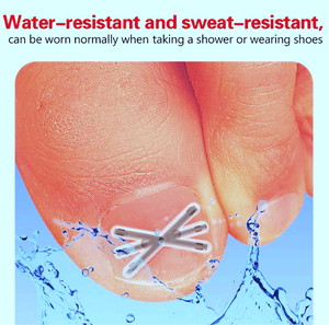 "Kit Corrector de Uñas Encarnadas-Soporte Ajustable de Metal y Silicona para Aliviar el Dolor, Adultos y Niños con Caja de Almacenamiento" - Product Image 4