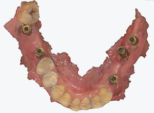 M6 Biomet 3i Pilier de numérisation dentaire en titane <span class=keywords><strong>compatible</strong></span> avec certains <span class=keywords><strong>implants</strong></span> - Product Image 4