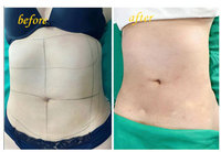 Portable 1470nm Endolaser Lifting Du Visage 980nm Diode Laser Liposuccion Lipolyse Machine De Perte De Poids
