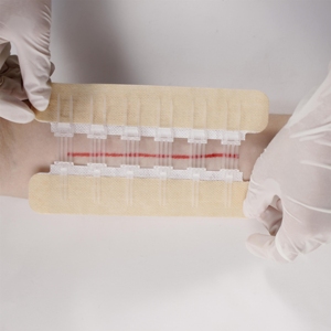 Dispositif de fermeture de plaie à fermeture éclair médicale pour les urgences - Product Image 4