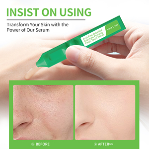 Ampollas blandas purificadoras antiacné botánicas sin ácido de etiqueta privada, tubos de suero facial para acné y brotes, productos de belleza - Product Image 4