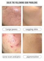 Kit Profesional de Exfoliación Facial con Esponja de Espículas de Zafiro Azul, Microagujas Naturales Bio, Venta al Por Mayor