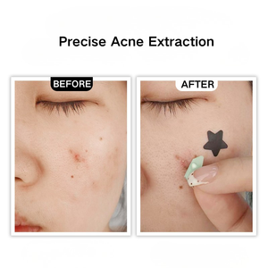 Cerotti Assorbenti per Acne in Idrocolloide, Patch Invisibili per Brufoli con Olio di Tea Tree, 28 Pezzi - Product Image 2