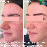 Machine à laser fractionné au CO2 CE Medical JONTELASER 70W MDSAP pour le rajeunissement de la peau du visage, l'élimination des cicatrices, le traitement de l'acné
