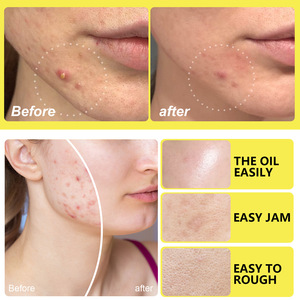 5-in-1 mụn vá rõ ràng mụn Bìa vá Sticker nhãn hiệu riêng Hydrocolloid mụn mụn các bản vá lỗi - Product Image 3