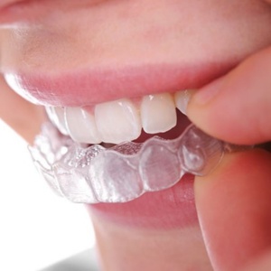 Manufacturer Supply Premium Food Grade Transparent Gel Tray Thermal Forming Mouth Guard CE Certified for <b>Teeth</b> <b>Whitening</b> Kit - Product Image 4