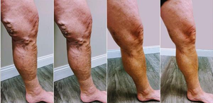 Eliminación de Telangiectasias, Arañas Vasculares y Varices con <span class=keywords><strong>Láser</strong></span> Vascular de 980nm y 1470nm, Ablación Vascular EVLA EVLT - Product Image 4