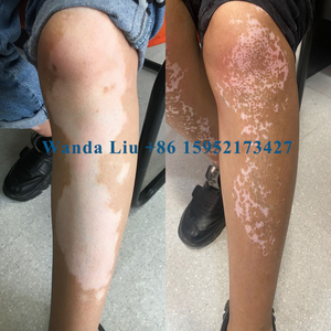 <span class=keywords><strong>Kernel</strong></span> duas lâmpadas compacta UVB Light Therapy Lamp <span class=keywords><strong>kernel</strong></span> fototerapia para tratamento caseiro vitiligo psoríase eczema - Product Image 5